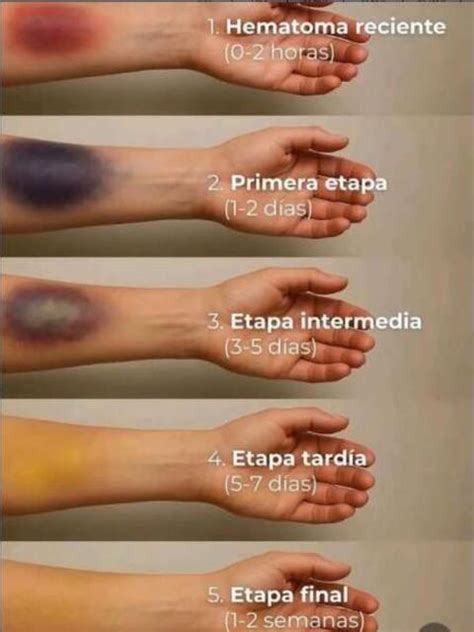 Fases de Hematomas | YUDOC.ORG | uDocz