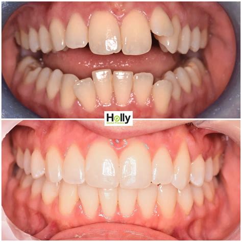 Can Invisalign Fix Canine Teeth
