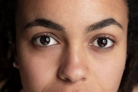 eye bag dark circle treatments  hifu