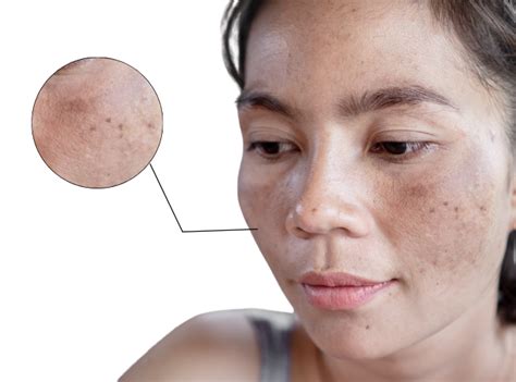 hori naevus pigment treatment  brisbane sydney