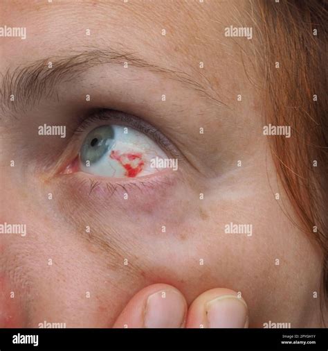Subconjunctival hemorrhage or subconjunctival bleeding, hyposhagmus ...