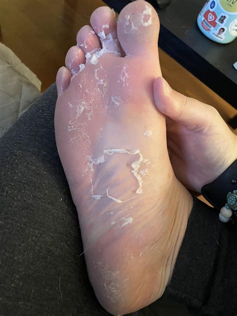 The sole reason I do foot masks : r/peeling
