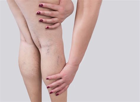 Spider Veins vs Varicose Veins | Vascular Institute of VA