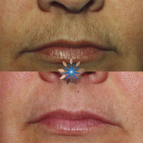 Laser Hair Removal in Washington, DC | Center for Laser Surgery