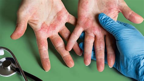 atopic dermatitis     topical steroids arent helping