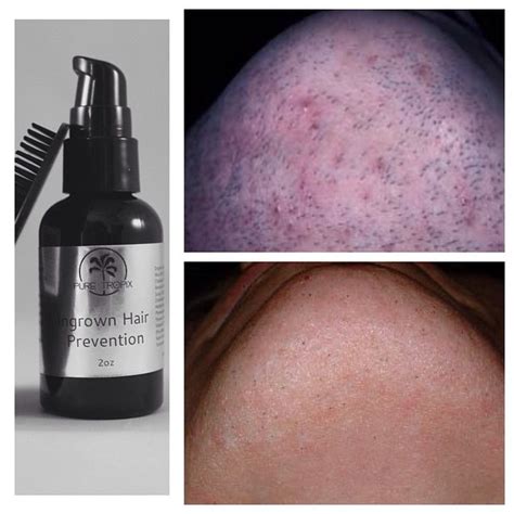 PureTropix: Ingrown hair treatment