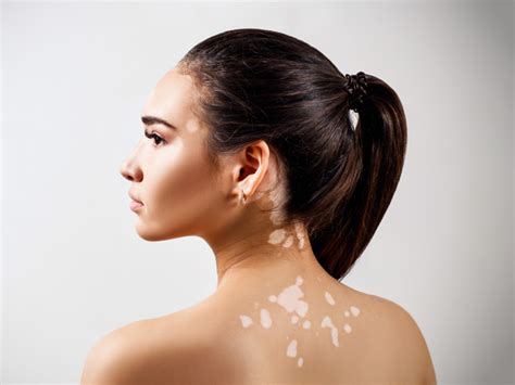 Vitiligo Overview: Types, Causes, Symptoms, and Treatment | Pfizer