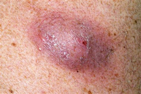 [DIAGRAM] Diagram Of Sebaceous Cyst - MYDIAGRAM.ONLINE