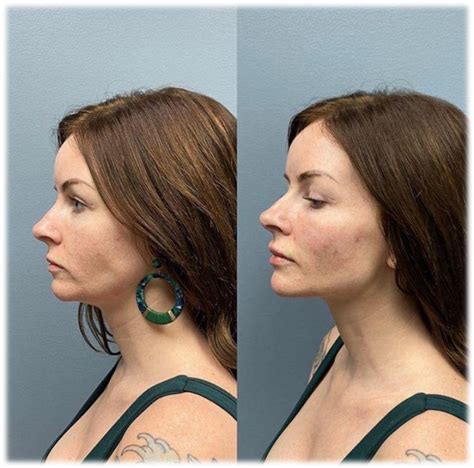 chin augmentation pol health care