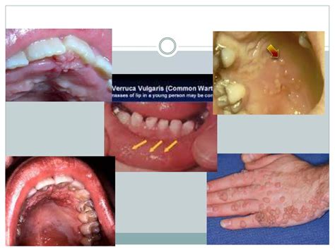 Human papillomavirus in the oral cavity of children | PPTX