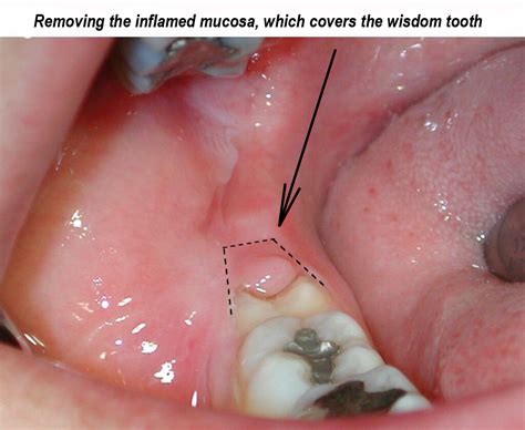 Treatment of pericoronitis | Ralev Dental Clinic