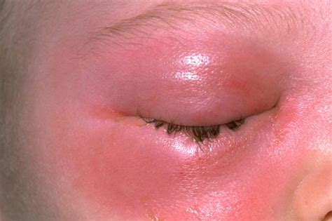 Eyelid problems | nidirect