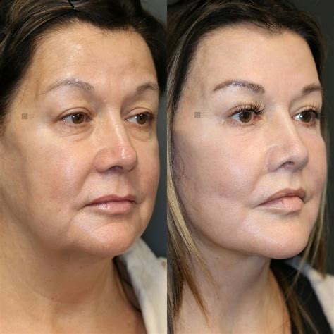face lift maintenance atlanta facelift specialists bfeena