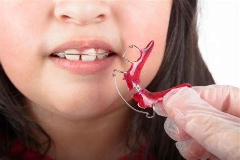 palatal expander works valley ranch orthodontics irving texas