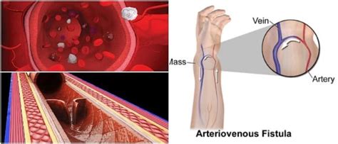Fístula Arteriovenosa: Tipos, Síntomas, Diagnostico, Causas y Tratamiento