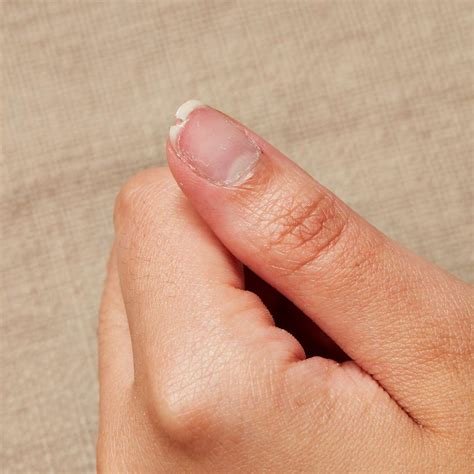 Smashed Fingernail
