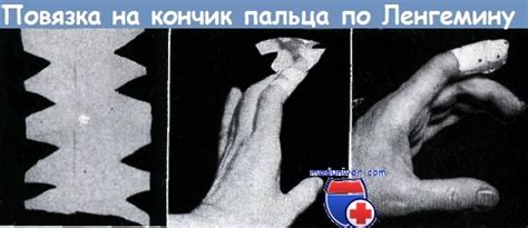 Принципы наложения повязки на кисть после операции