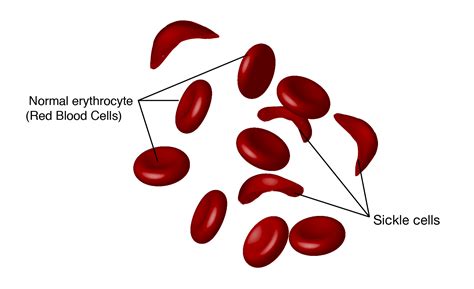 sickle cell disease
