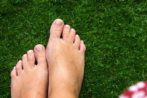 Living with Webbed Toes: Syndactyly in Humans