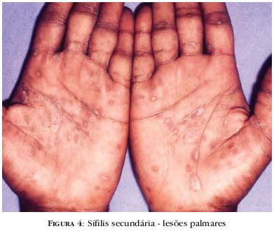 Sífilis Manchas Na Mão - SciELO Brasil - Sífilis: diagnóstico, tratamento e controle Sífilis ...