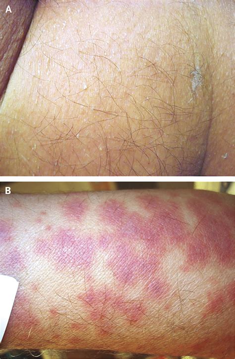 Prevention as Precipitant | New England Journal of Medicine
