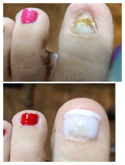 Cosmetic Nail Reconstruction - The Institute of Podiatrists The