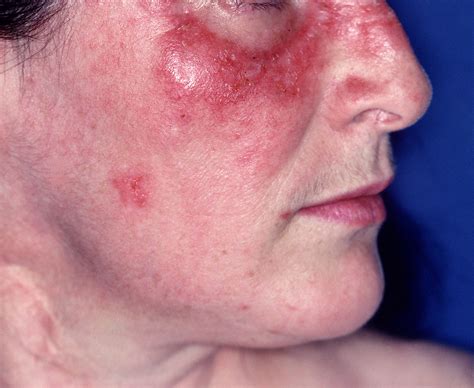 B-Cell Depletion Therapy With Rituximab Effective for Cutaneous Lupus