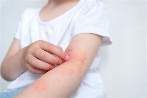 Increases in Anaphylaxis Among Children, Adolescents Require Targeted