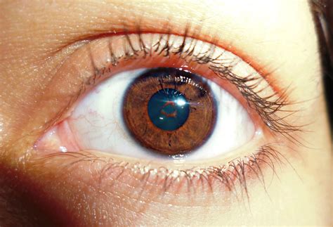 Persistent Pupillary Membrane