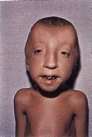 Medical Treatment Pictures-for Better Understanding: Seckel Syndrome