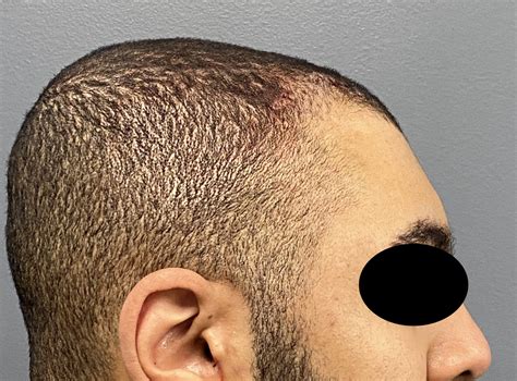 Plastic Surgery Case Study - Male Forehead Reshaping with Combined Brow