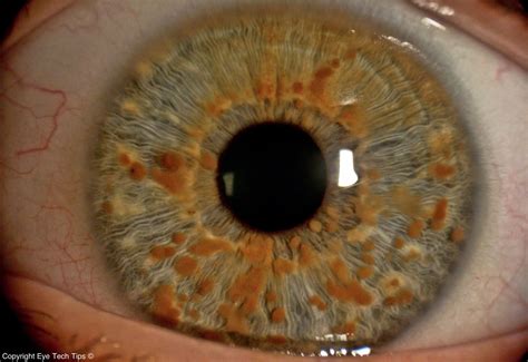Iris Eye White Spot at Arnetta Parker blog