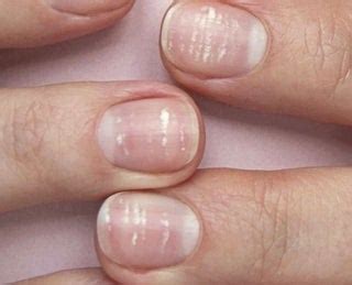 Porque As Unhas Ficam Com Manchas Brancas - Por que minhas unhas estão com manchas brancas? A verdade que ninguém ...