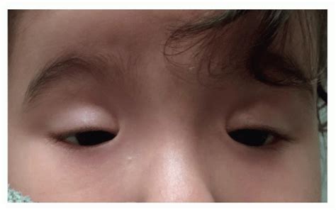 Pediatric Ptosis Repair: Blepharophimosis Syndrome | Ento Key