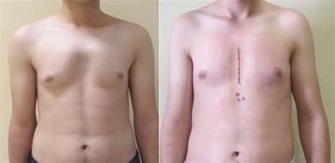 Pectus Carinatum Surgery and Treatments Options in Turkey - Dr.Pectus