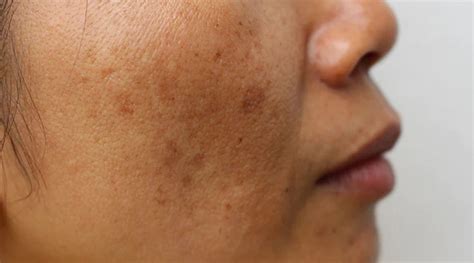 stress  anxiety  lead  skin dullness