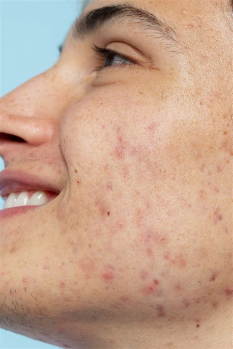 Pele Oleosa E Acneica - Pele Acneica - Guia Completo Para Uma Pele Saudável E Livre De Acne
