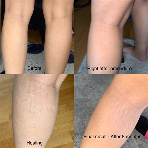 fitness stretch marks