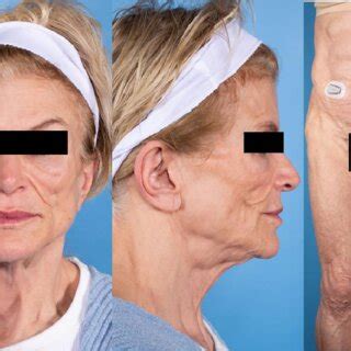 month follow   generalized lipodystrophy