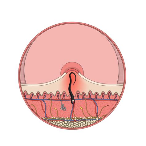 What Does An Infected Ingrown Hair Look Like? | Ingrown Hair Cyst