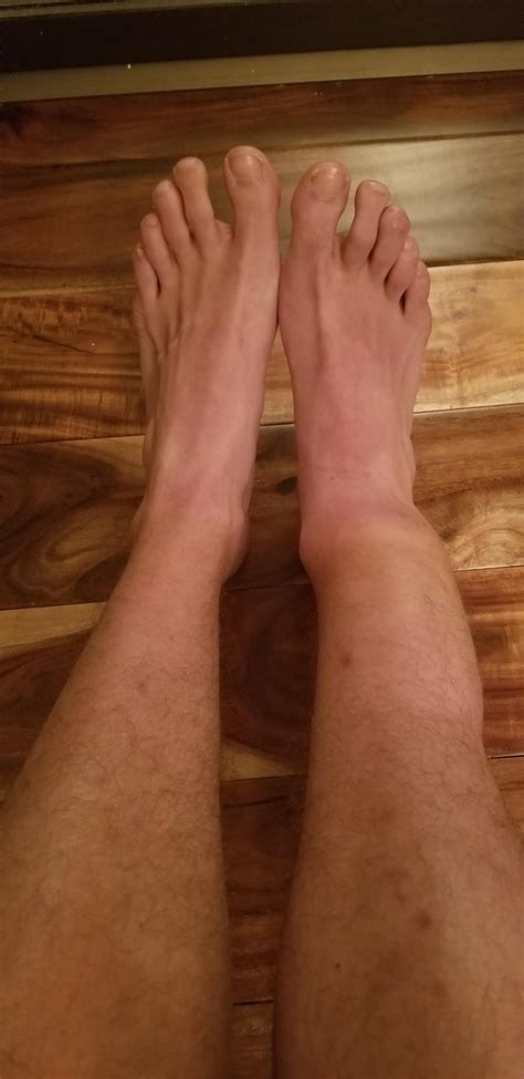 Does the swelling above my right ankle resemble a break or a sprain