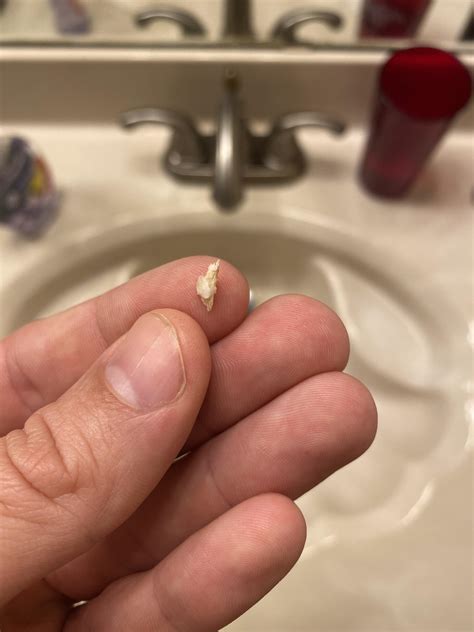 Bone spur pulled out of my gums. : r/mildlyinteresting