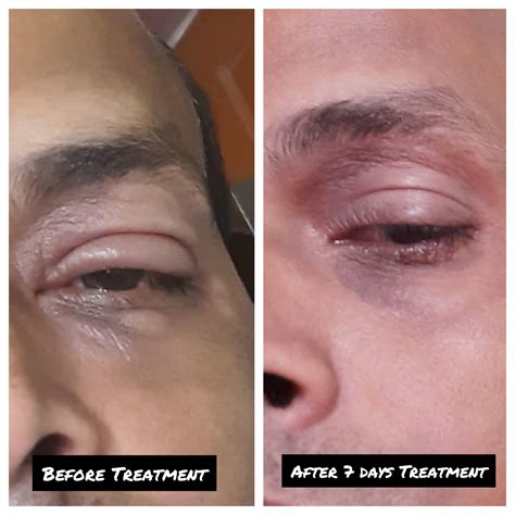 How to cure blepharitis fast? Know the Homeopathy Remedies