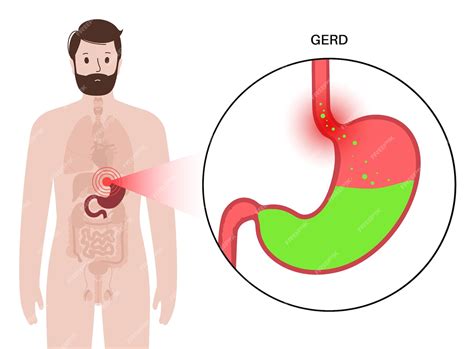premium vector gastroesophageal reflux disease poster digestive