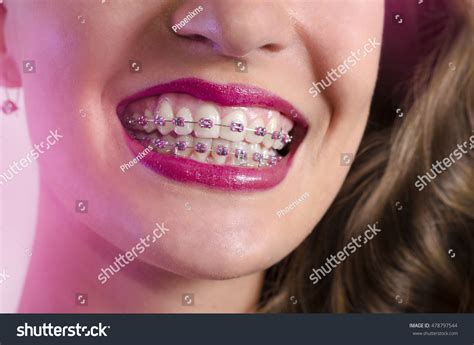 braces  teeth pink