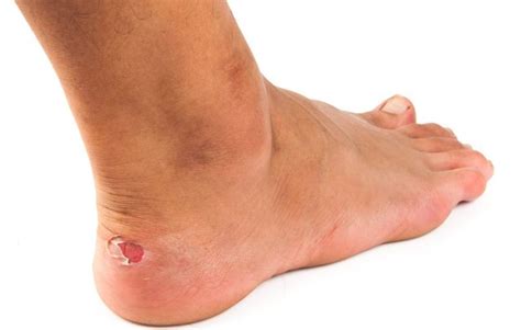 How To Prevent Blisters | Prevention