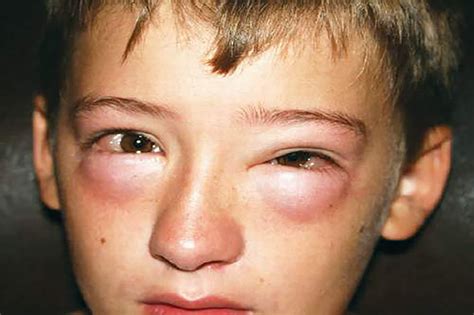 Anaphylactic Shock - Homecare24
