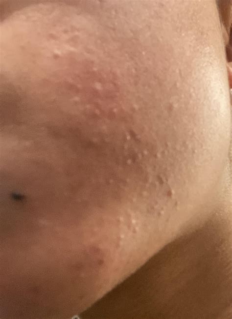 Tiny itchy bumps : r/skin