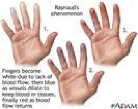 raynaud  syndrome artofit