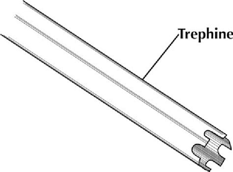 Figure 1 from Techniques for Suture Anchor Removal in Shoulder Surgery ...